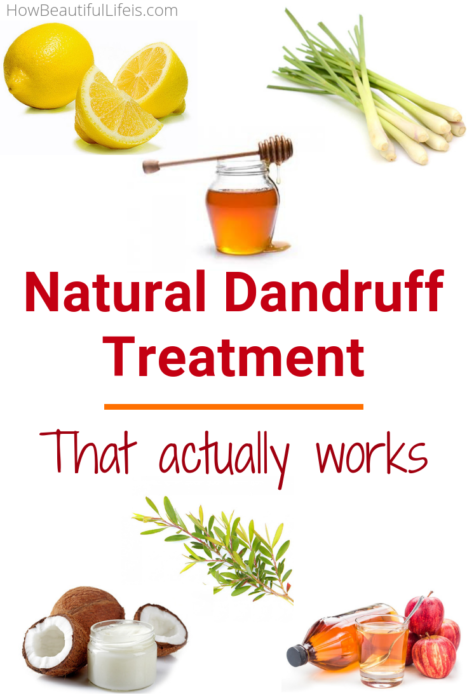 How to Get Rid of Dandruff Using Natural Treatments That Actually Work #dandruff #dandruffsolution #scalp #itchyscalp