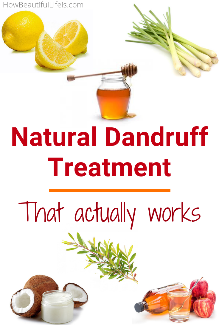 Natural Dandruff Treatment | How Beautiful Life Is