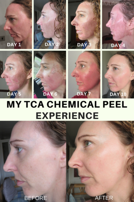 My TCA Chemical Peel Experience