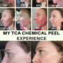 My TCA Chemical Peel Experience
