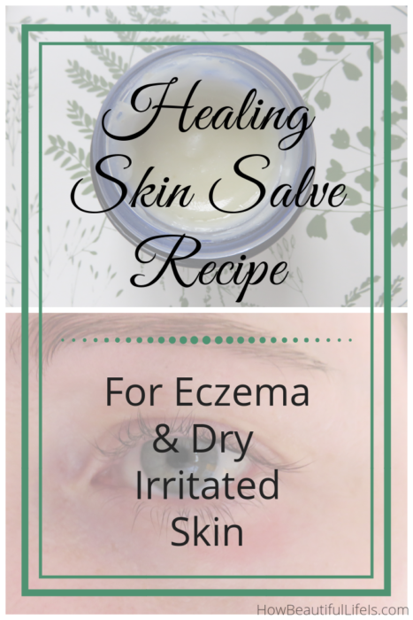 All-natural salve recipe for eczema and dry, irritated skin #eczema #eczematreatment #diybeauty